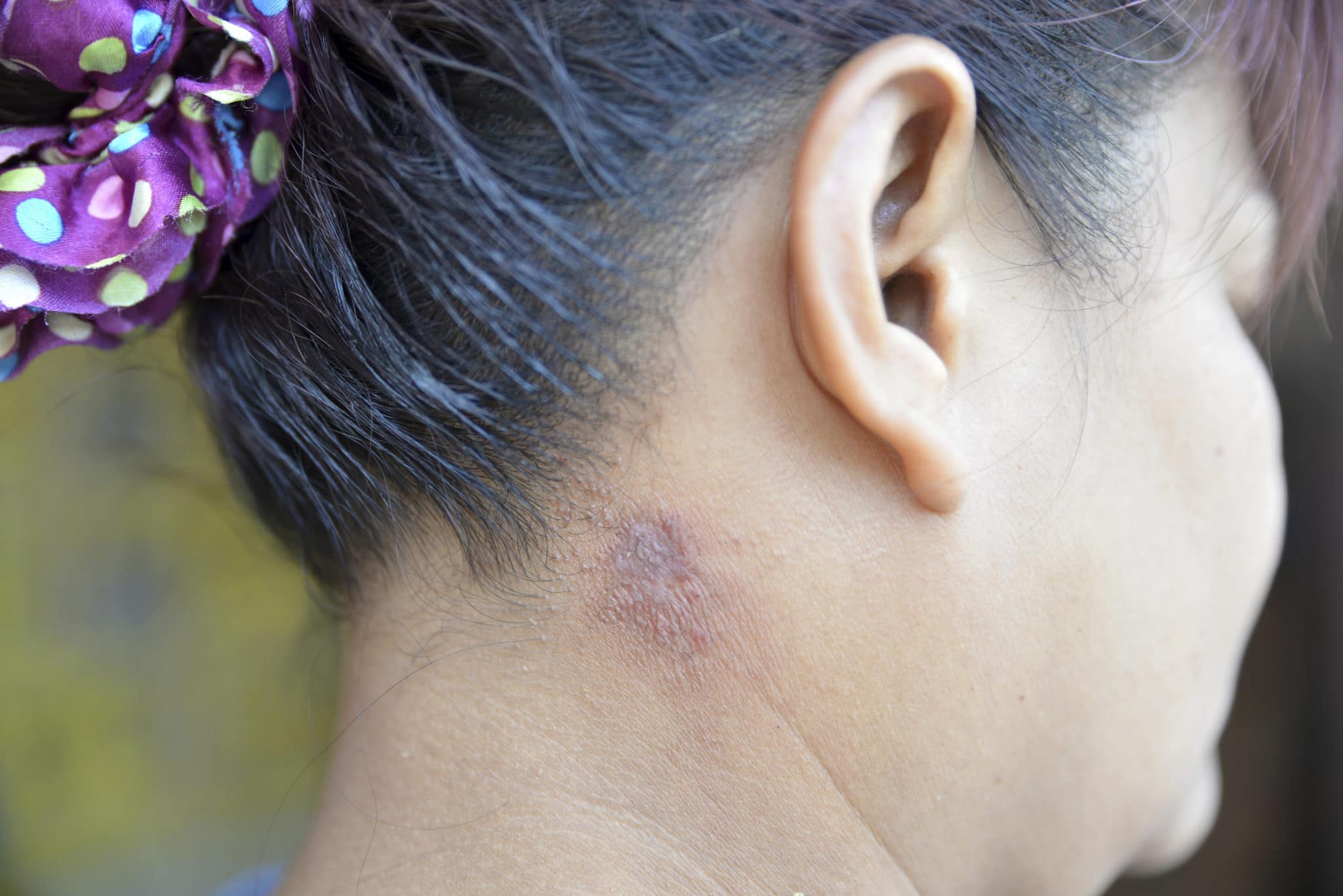 Facial Skin Cancer Ear, Nose and Throat, LTD